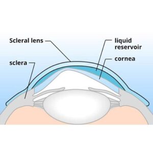 لنز اسکلرال (SCLERAL) در غواصی